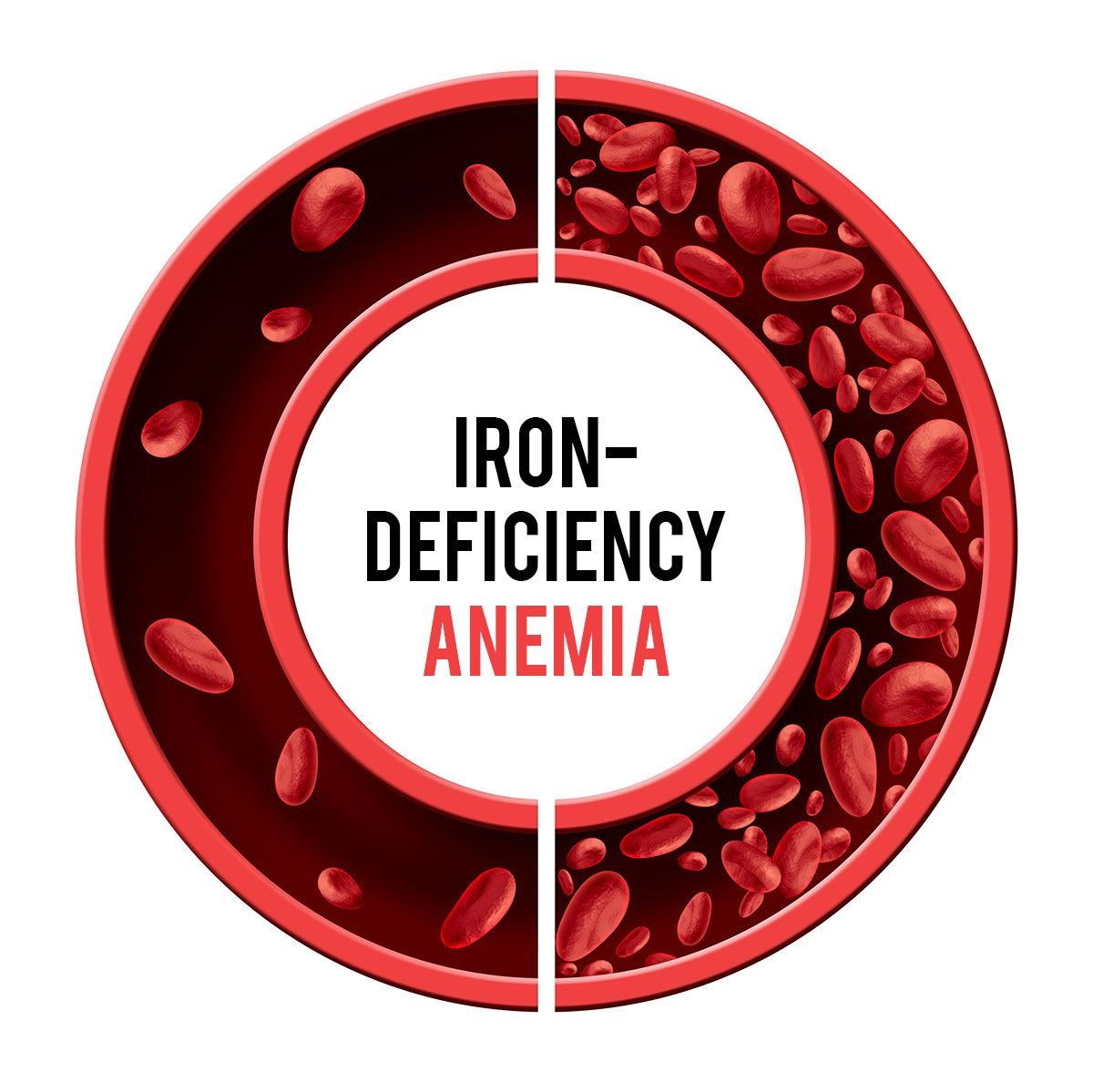 Iron Deficiency vs Vitamin B12 Deficiency: What's the Difference?